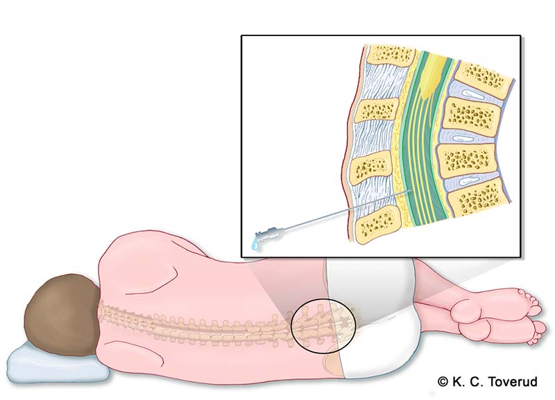 epidural