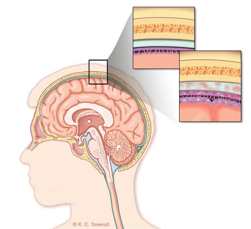 meningene