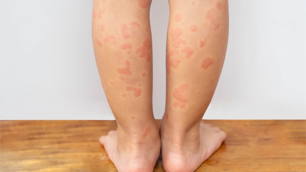 Urticaria og elveblest