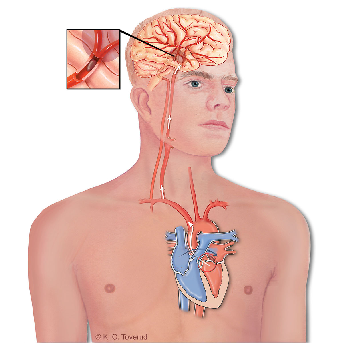 Atrieflimmer og slag. Illustrasjon av Kari C Toverud CMI